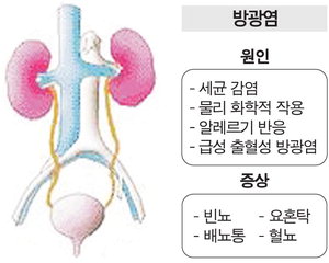 여자를 노리는 방광염…환자 90% 차지 : 부산의 대표 정론지, 국제신문