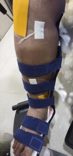 �νŸŸ� Ż���ϴ� ��ģ �ܱ���, ġ��� ��ź���� ������